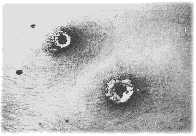 Eschar Formation